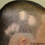 Alopecia_areata_1_low