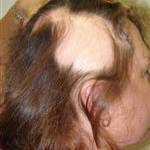 Alopecia_areata_2_low